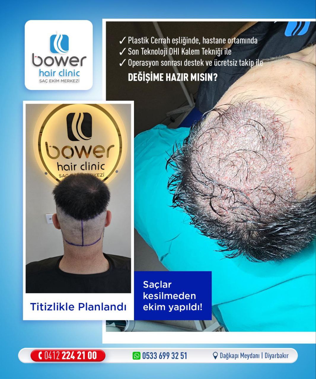 Özel Bower Hospital Hastanesi Saç Ekim Birimi